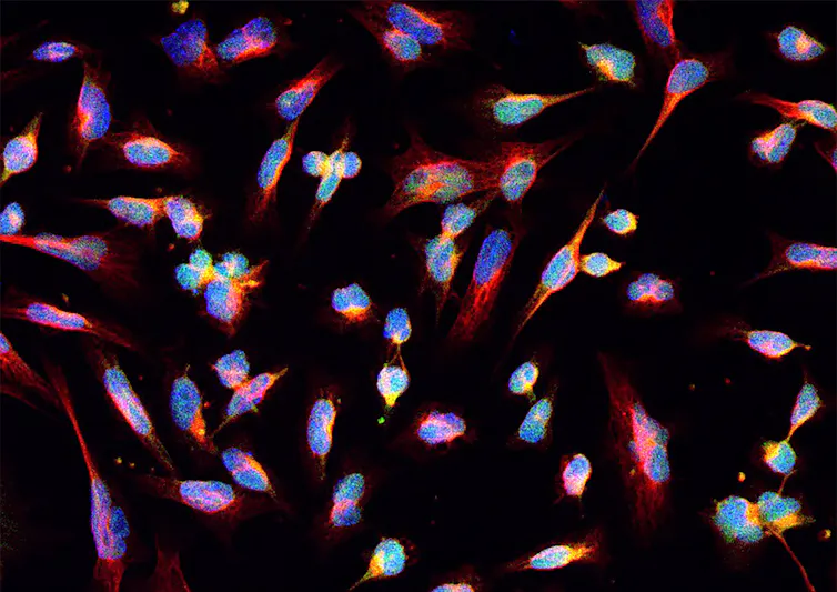 Microscopy image of glioma cells