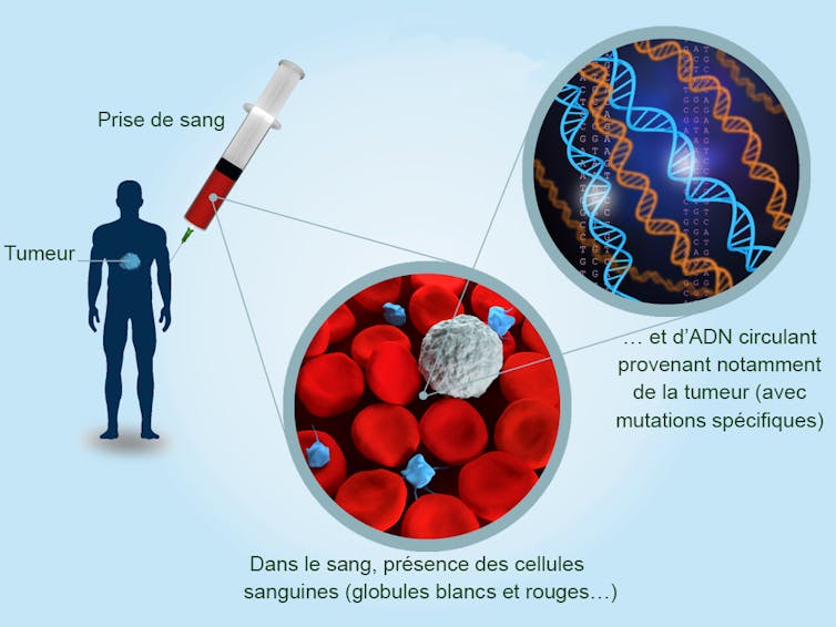 Infographie schématisant la récupération d’ADNc : prise de sang, composition du sang et présence d’ADN cancéreux