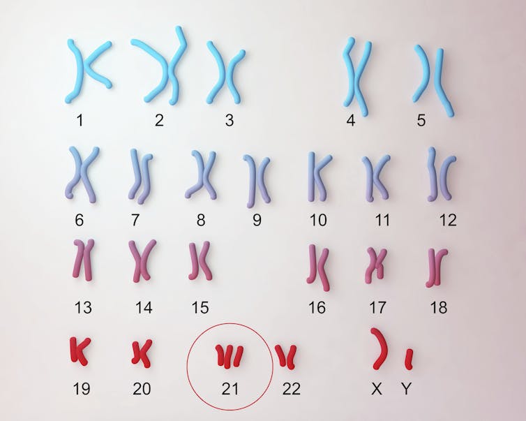 Karyotype of Down syndrome, with a circle around three copies of chromosome 21