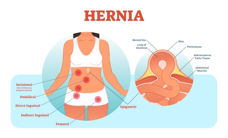 Graphic of woman's body and different types of hernia