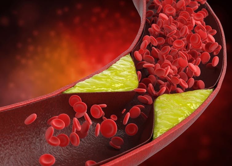 A graphic of plaque blocking an artery.