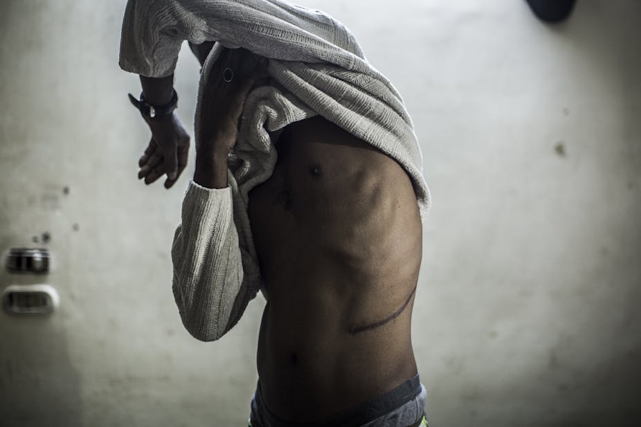 A man lifts his shirt to show a scar