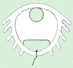 Sketch of a Dalkon shield IUD