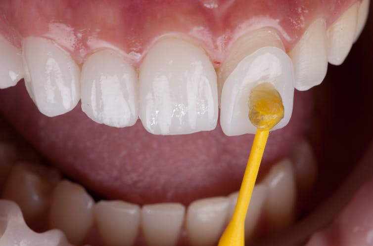tooth cover being added to natural teeth