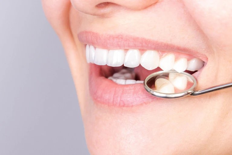 smile with very white straight teeth and dental mirror