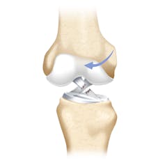 Graphic of an ACL tear