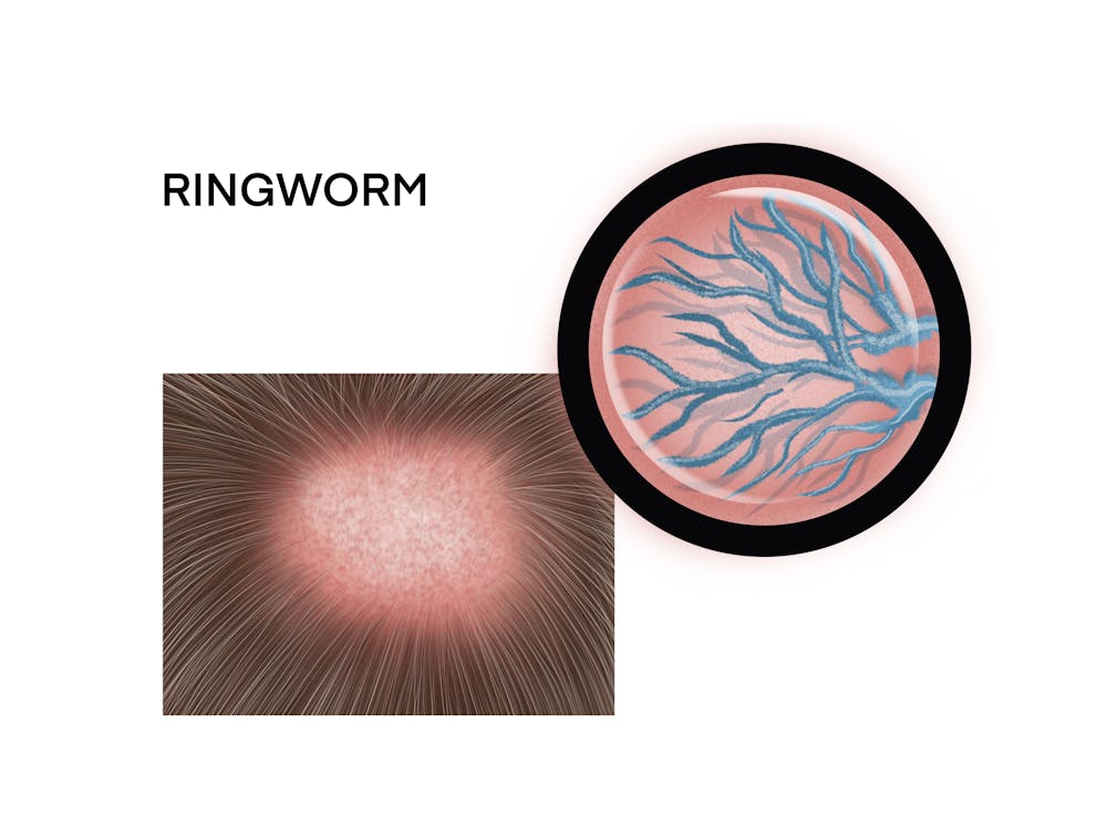 early ringworm in humans
