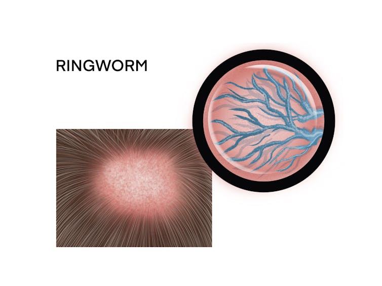 Top view of a scalp with hair missing in the circlular shape of a ringworm infection.