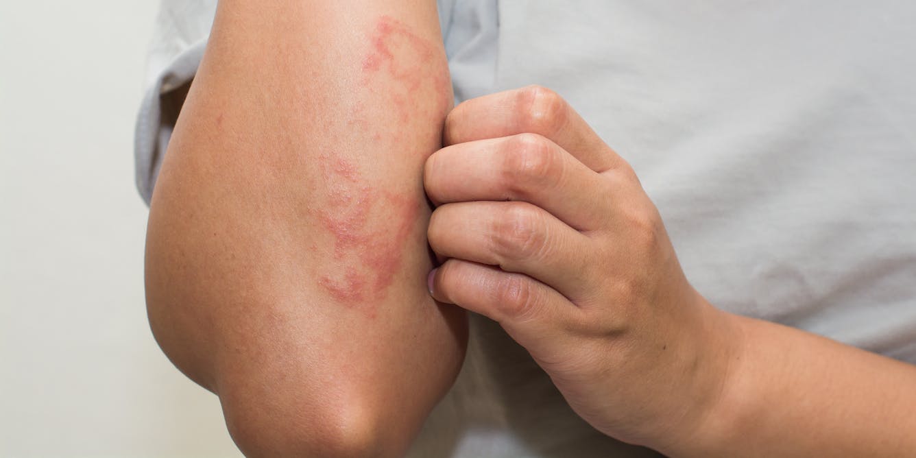 How to Lighten Eczema Scars and Prevent Further Skin Aging