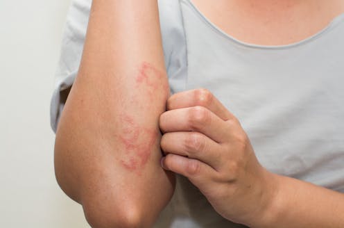 Why is eczema sometimes treated with a diluted bleach bath? And what do I need to know before trying it?