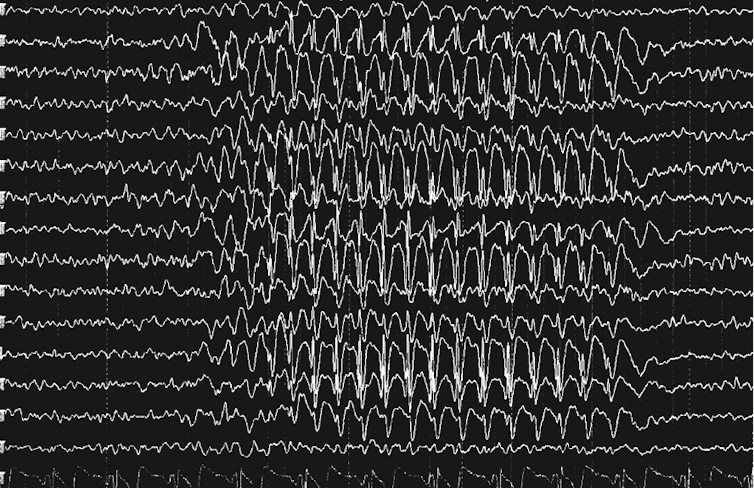 EEG montrant une crise d’épilepsie avec des ondes très chaotiques