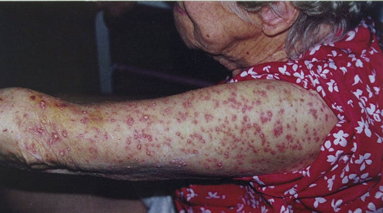 an elderly woman's arm covered in pustules from ant bites