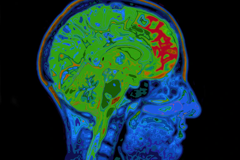 MRI Image of brain.