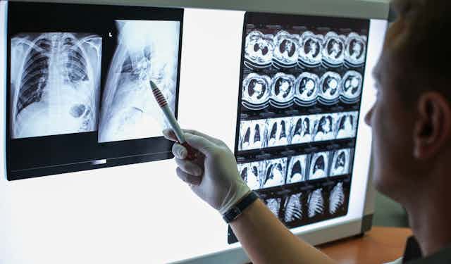 Medical person looking at scans of lungs