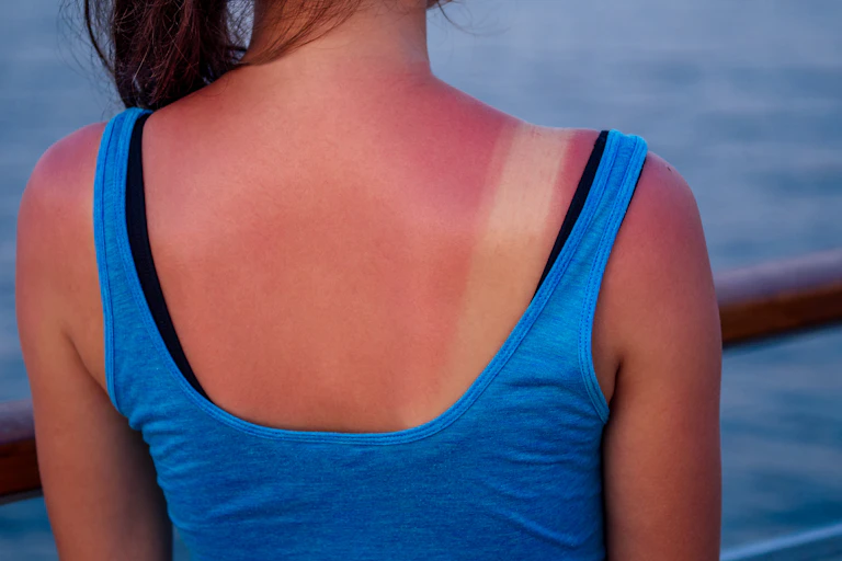 Dos d'une jeune femme avec un coup de soleil aux épaules.