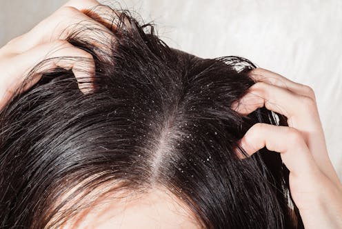 What is dandruff? How do I get rid of it? Why does it keep coming back?
