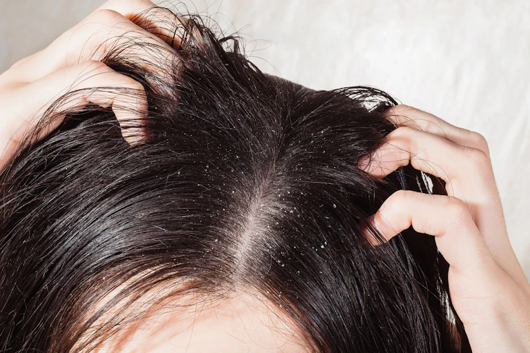 Person scratching head with dandruff visible in dark hair