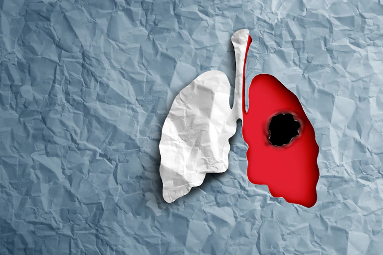 Image of lungs. One with a burn mark on it