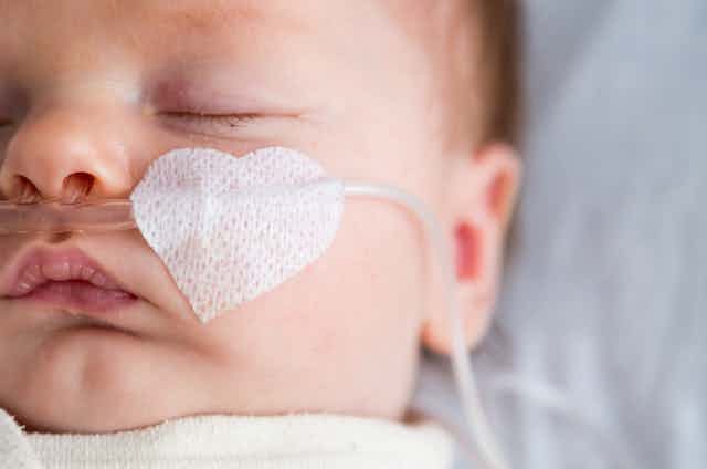 Baby with oxygen tubes