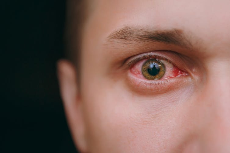 Close-up of a man's red irritated eye coated in tears