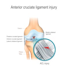 A medical diagram shows the location of the ACL, a ligament behind the knee cap that can tear during quick changes of direction