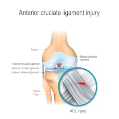 Un diagrama médico muestra la ubicación del LCA, un ligamento situado detrás de la rótula que puede romperse durante los cambios rápidos de dirección