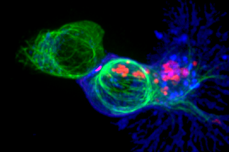 Immune Cells That Fight Cancer Become Exhausted Within Hours of First Encountering Tumors – New Research