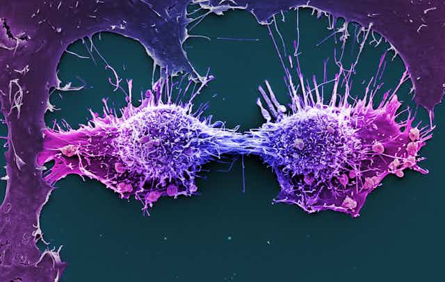 HeLa cells dividing: microscopic image of cells dyed blue and pink