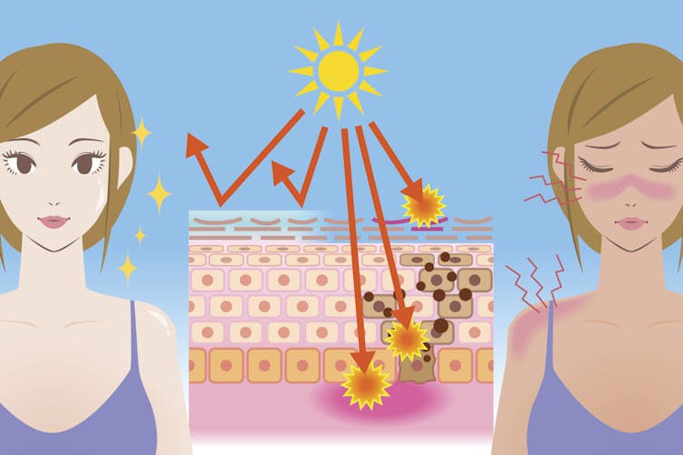 Cartoon of a young female on the left before sunburn and on the right with a sunburned face with sunrays hitting an illustration of the skin layers in the middle