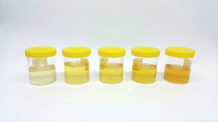 sampel urin berbaris.