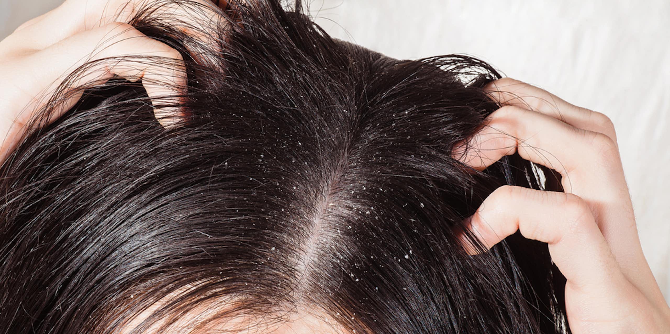 Person scratching head with dandruff visible in dark hair