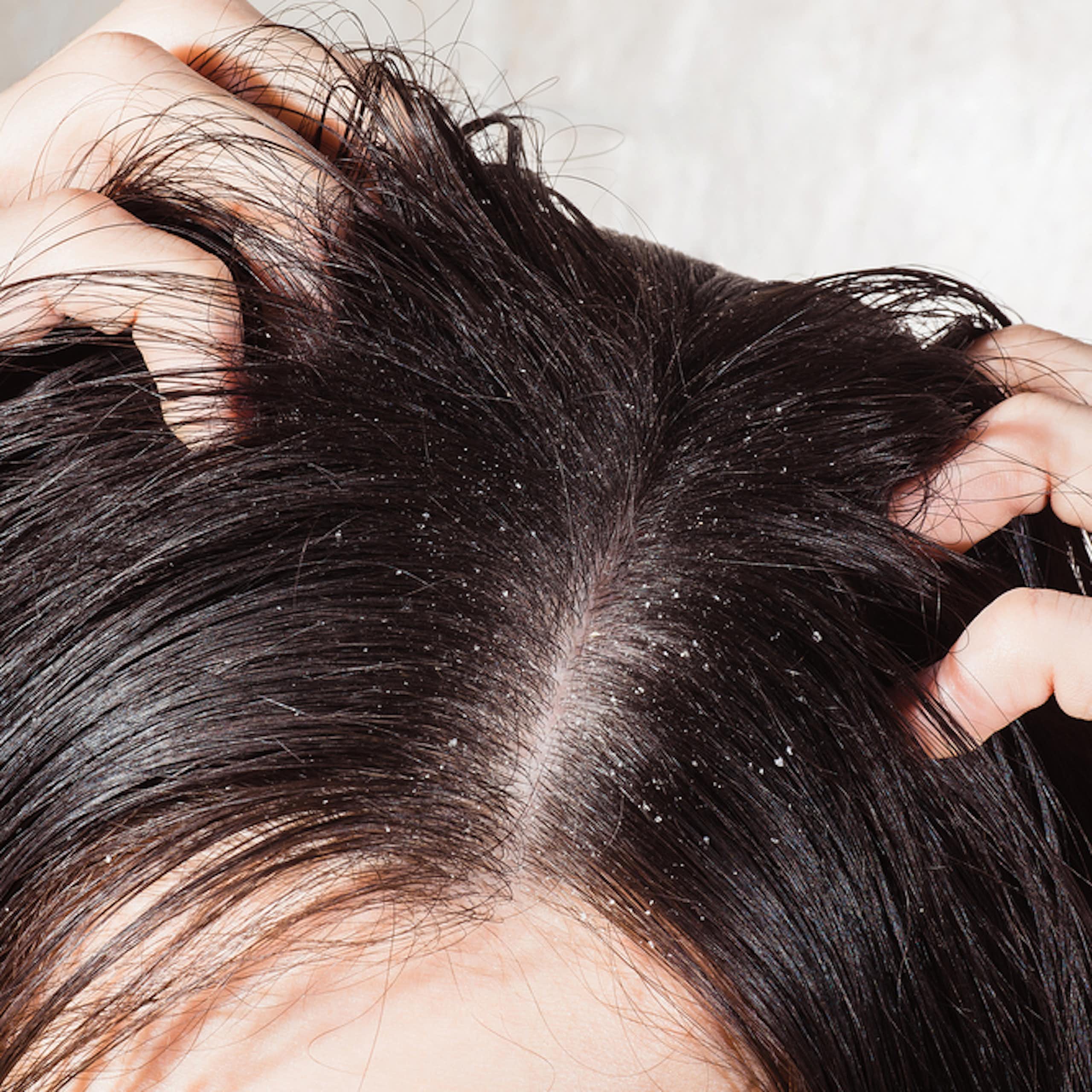 Person scratching head with dandruff visible in dark hair