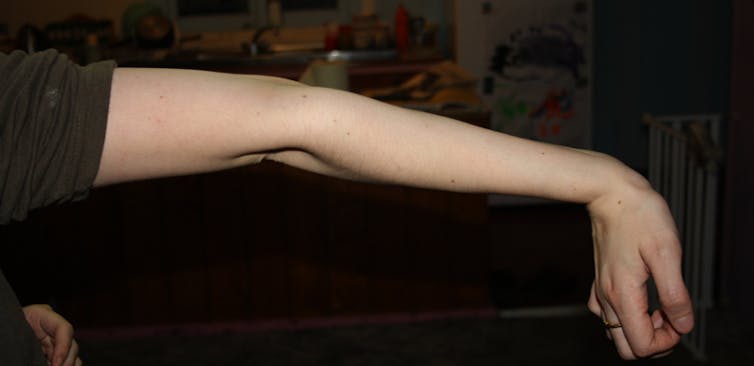 A woman's arm is flexed beyond straight at the elbow.