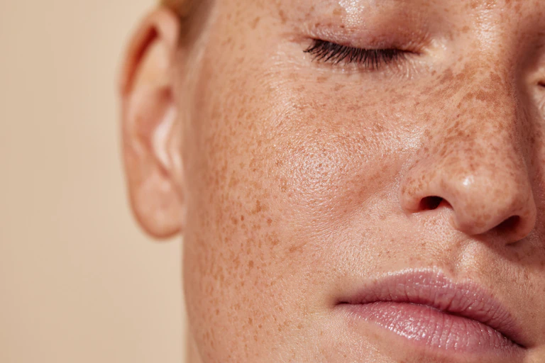 Close-up of person's freckled face