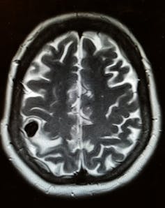 brain scan