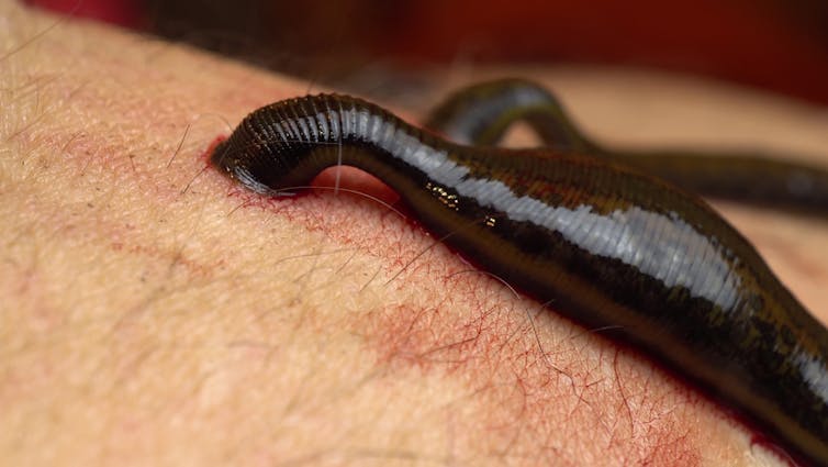 A medical leech sucking blood from a human