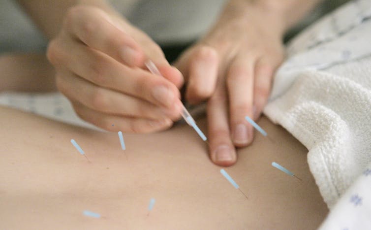 Two hands insert a needle into a patient's back, which is partially covered with a towel and which already has seven needles stuck in two lines.