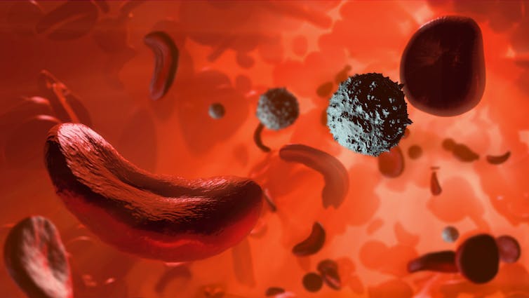 Illustration of sickle-shaped cells in the bloodstream surrounded by normal round red blood cells and white blood cells.