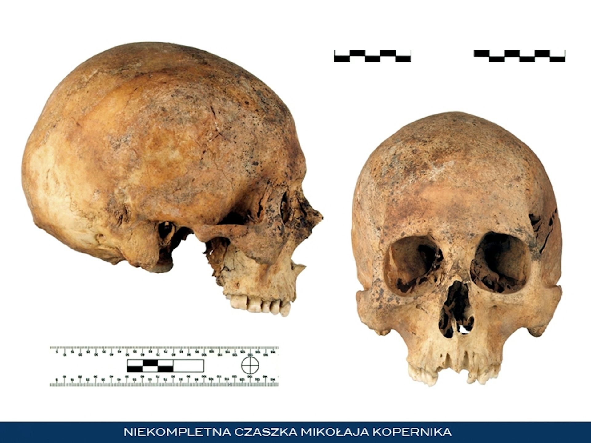 Photos of a human skull from the front and side with a ruler indicating size.