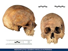 Photos of a human skull from the front and side.