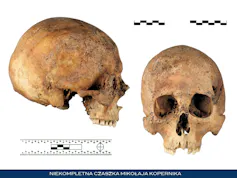 Photos of a human skull from the front and side.