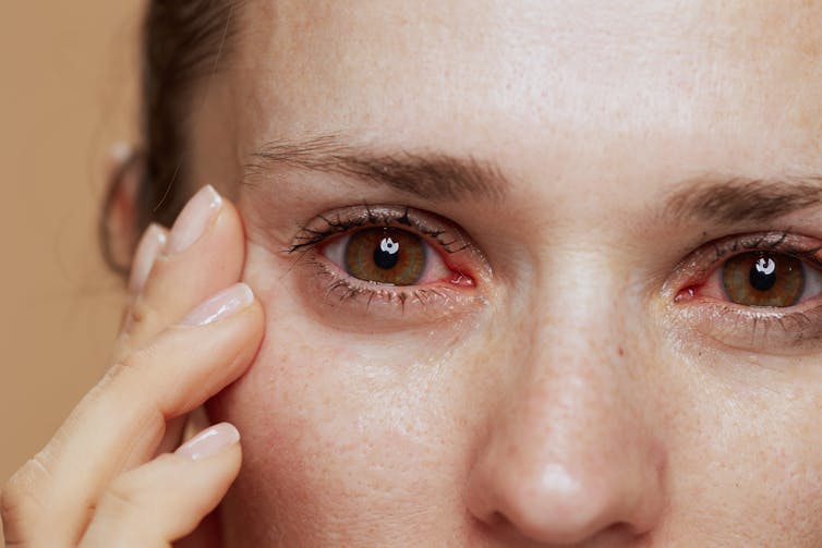 Woman with red eyes touches her face