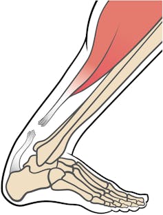 Drawing of bent foot with torn tendon.
