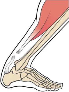 Drawing of bent foot with torn tendon.