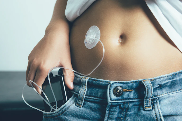Close-up of insulin pump attached to a person's stomach