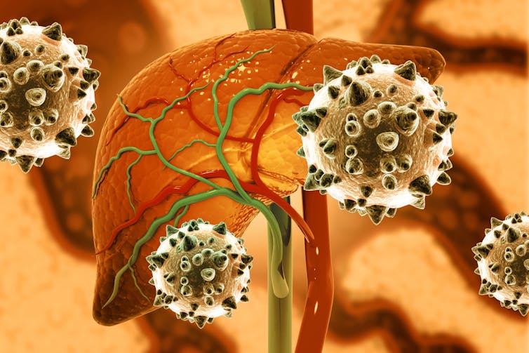 A digital drawing of a liver being attacked by hepatitis C viruses.
