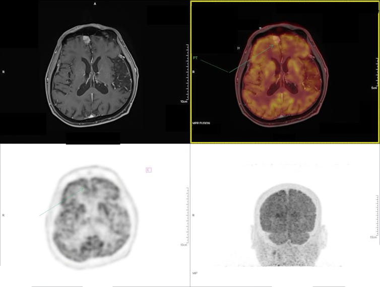 Four brain scans, two in contrasted colors with the background shown as white and the brain as gray, two with the background shown as black and the brain shown either as gray or orange.
