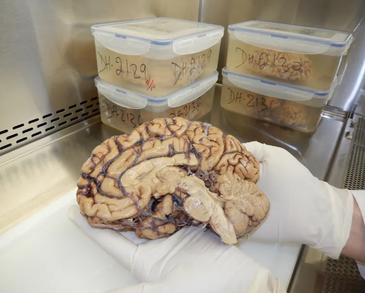 cerebral hemisphere