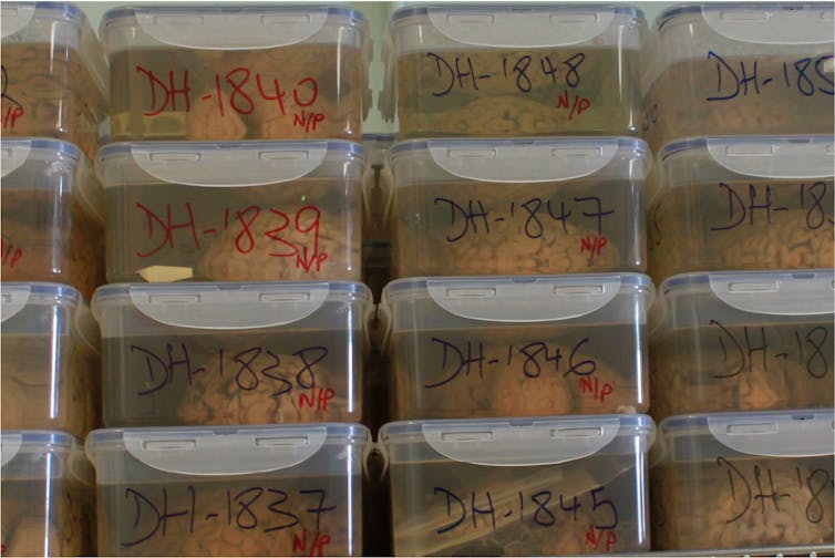 Cerebral hemispheres preserved in formalin