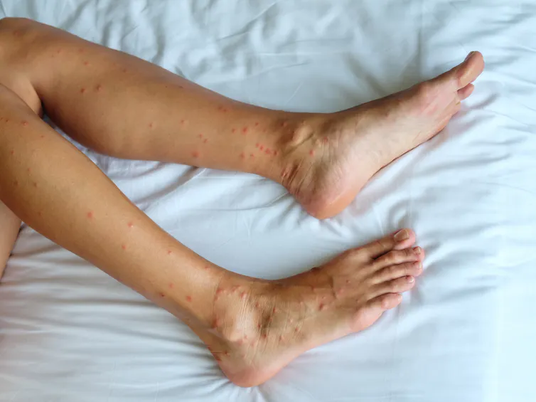 Les jambes d’une femme, reposant sur un drap, sont recouvertes de boutons rouges.